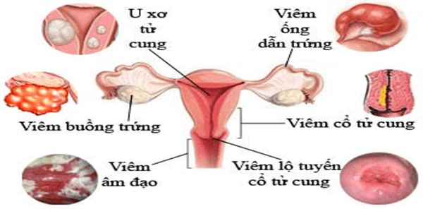Những bệnh phụ khoa thường gặp Những bệnh phụ khoa thường gặp