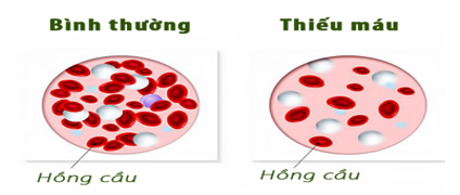 Thiếu máu: Nguyên nhân, triệu chứng, chẩn đoán và điều trị